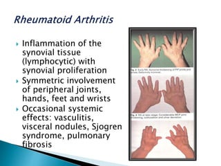  Inflammation of the
synovial tissue
(lymphocytic) with
synovial proliferation
 Symmetric involvement
of peripheral joints,
hands, feet and wrists
 Occasional systemic
effects: vasculitis,
visceral nodules, Sjogren
syndrome, pulmonary
fibrosis
 