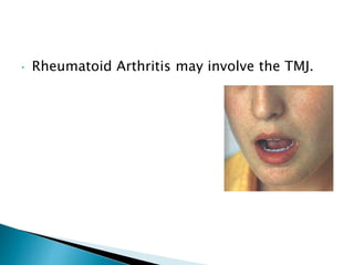  Rheumatoid Arthritis may involve the TMJ.
 
