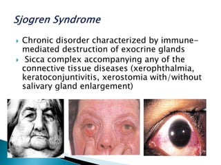  Chronic disorder characterized by immune-
mediated destruction of exocrine glands
 Sicca complex accompanying any of the
connective tissue diseases (xerophthalmia,
keratoconjuntivitis, xerostomia with/without
salivary gland enlargement)
 