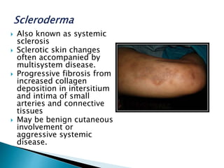  Also known as systemic
sclerosis
 Sclerotic skin changes
often accompanied by
multisystem disease.
 Progressive fibrosis from
increased collagen
deposition in intersitium
and intima of small
arteries and connective
tissues
 May be benign cutaneous
involvement or
aggressive systemic
disease.
 