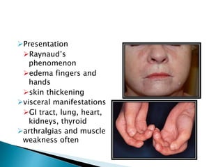 Presentation
Raynaud’s
phenomenon
edema fingers and
hands
skin thickening
visceral manifestations
GI tract, lung, heart,
kidneys, thyroid
arthralgias and muscle
weakness often
 