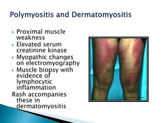  Proximal muscle
weakness
 Elevated serum
creatinine kinase
 Myopathic changes
on electromyography
 Muscle biopsy with
evidence of
lymphocytic
inflammation
Rash accompanies
these in
dermatomyositis
 