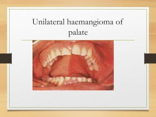 Unilateral haemangioma of
palate
 