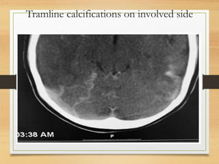 Tramline calcifications on involved side
 