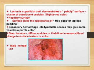  Lesion is superficial and demonstrates a “ pebbly” surface –
cluster of translucent vesicles. Slightly red color.
Papillary surface
 Surface gives the appearance of “ frog eggs”or tapioca
pudding.
Secondary hemorrhage into lymphatic spaces may give some
vesicles a purple color.
Deep lesions – diffuse nodules or ill-defined masses without
change in surface texture or color.
 Male : female
- 2:1
 