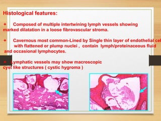 Histological features:
 Composed of multiple intertwining lymph vessels showing
marked dilatation in a loose fibrovascular stroma.
 Cavernous most common-Lined by Single thin layer of endothelial cel
with flattened or plump nuclei , contain lymph/proteinaceous fluid
and occasional lymphocytes.
 Lymphatic vessels may show macroscopic
cyst like structures ( cystic hygroma )
 