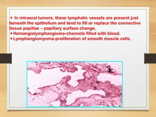  In intraoral tumors, these lymphatic vessels are present just
beneath the epithelium and tend to fill or replace the connective
tissue papillae – papillary surface change.
Hemangiolymphangioma-channels filled with blood.
Lymphangiomyoma-proliferation of smooth muscle cells.
 
