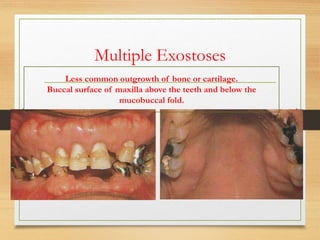Multiple Exostoses
Less common outgrowth of bone or cartilage.
Buccal surface of maxilla above the teeth and below the
mucobuccal fold.
 