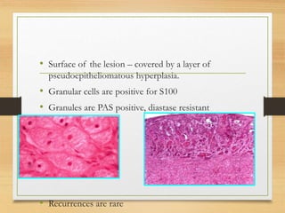 • Surface of the lesion – covered by a layer of
pseudoepitheliomatous hyperplasia.
• Granular cells are positive for S100
• Granules are PAS positive, diastase resistant
• Recurrences are rare
 