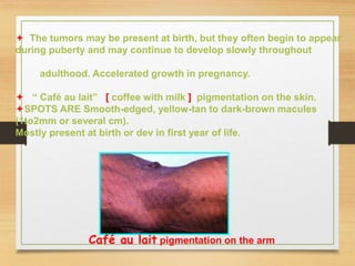  The tumors may be present at birth, but they often begin to appear
during puberty and may continue to develop slowly throughout
adulthood. Accelerated growth in pregnancy.
 “ Café au lait” [ coffee with milk ] pigmentation on the skin.
SPOTS ARE Smooth-edged, yellow-tan to dark-brown macules
(1to2mm or several cm).
Mostly present at birth or dev in first year of life.
Café au lait pigmentation on the arm
 