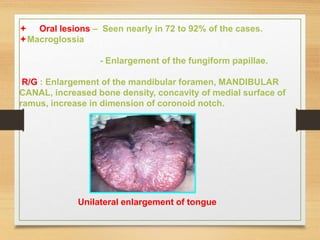  Oral lesions – Seen nearly in 72 to 92% of the cases.
Macroglossia
- Enlargement of the fungiform papillae.
R/G : Enlargement of the mandibular foramen, MANDIBULAR
CANAL, increased bone density, concavity of medial surface of
ramus, increase in dimension of coronoid notch.
Unilateral enlargement of tongue
 