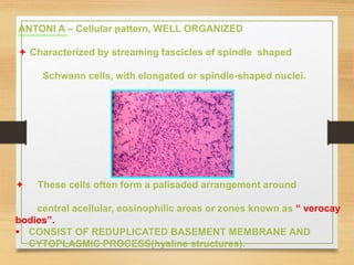 ANTONI A – Cellular pattern, WELL ORGANIZED
 Characterized by streaming fascicles of spindle shaped
Schwann cells, with elongated or spindle-shaped nuclei.
 These cells often form a palisaded arrangement around
central acellular, eosinophilic areas or zones known as “ verocay
bodies”.
 CONSIST OF REDUPLICATED BASEMENT MEMBRANE AND
CYTOPLASMIC PROCESS(hyaline structures).
 