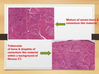 Mixture of woven bone &
cementum like material.
Trabeculae
of bone & droplets of
cementum like material
within a background of
fibrous CT.
 