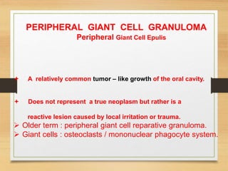 PERIPHERAL GIANT CELL GRANULOMA
Peripheral Giant Cell Epulis
 A relatively common tumor – like growth of the oral cavity.
 Does not represent a true neoplasm but rather is a
reactive lesion caused by local irritation or trauma.
 Older term : peripheral giant cell reparative granuloma.
 Giant cells : osteoclasts / mononuclear phagocyte system.
 