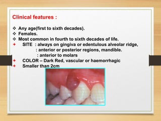 Clinical features :
 Any age(first to sixth decades).
 Females.
 Most common in fourth to sixth decades of life.
 SITE : always on gingiva or edentulous alveolar ridge,
: anterior or posterior regions, mandible.
: anterior to molars
 COLOR – Dark Red, vascular or haemorrhagic
 Smaller than 2cm
 
