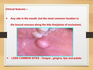 Clinical features :-
 Any site in the mouth, but the most common location is
the buccal mucosa along the bite line(plane of occlusion).
 LESS COMMON SITES : Tongue , gingiva, lips and palate.
 
