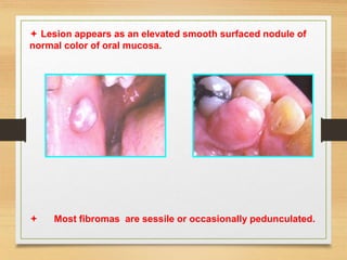  Lesion appears as an elevated smooth surfaced nodule of
normal color of oral mucosa.
 Most fibromas are sessile or occasionally pedunculated.
 