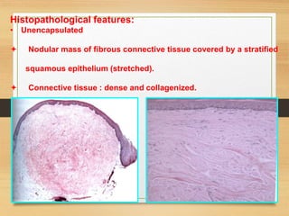 Histopathological features:
• Unencapsulated
 Nodular mass of fibrous connective tissue covered by a stratified
squamous epithelium (stretched).
 Connective tissue : dense and collagenized.
 