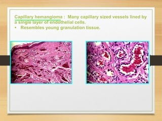 Capillary hemangioma : Many capillary sized vessels lined by
a single layer of endothelial cells.
 Resembles young granulation tissue.
 