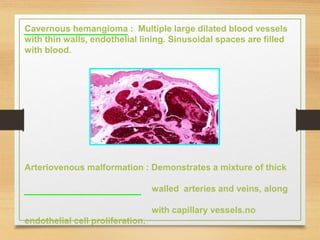 Cavernous hemangioma : Multiple large dilated blood vessels
with thin walls, endothelial lining. Sinusoidal spaces are filled
with blood.
Arteriovenous malformation : Demonstrates a mixture of thick
walled arteries and veins, along
with capillary vessels.no
endothelial cell proliferation.
 