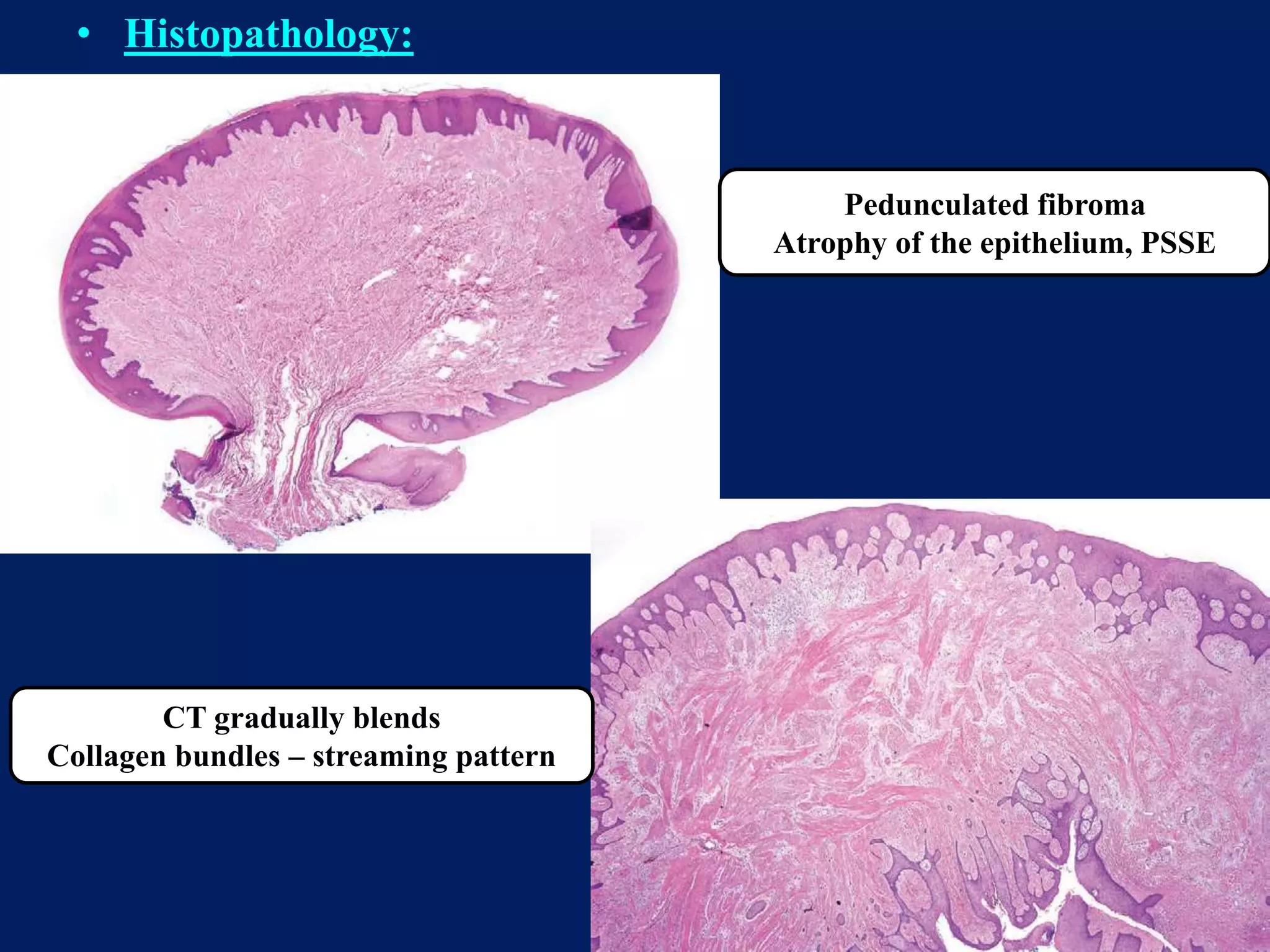 benign and malignant tumors of connective tissue origin | PPTX