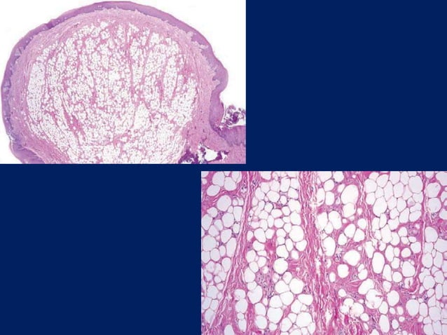 benign and malignant tumors of connective tissue origin | PPTX | Dental ...