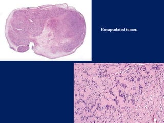 benign and malignant tumors of connective tissue origin | PPTX