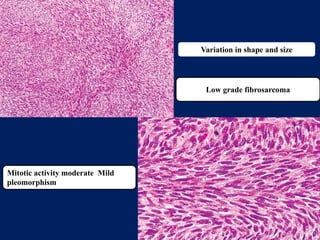 benign and malignant tumors of connective tissue origin | PPTX