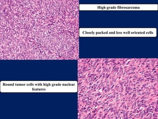 benign and malignant tumors of connective tissue origin | PPTX