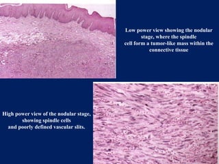 benign and malignant tumors of connective tissue origin | PPTX