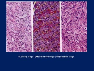 benign and malignant tumors of connective tissue origin | PPTX