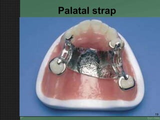 Palatal strap
19
 