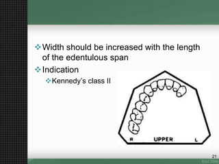 Width should be increased with the length
of the edentulous span
Indication
Kennedy’s class II
21
 