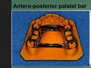 Antero-posterior palatal bar
23
 
