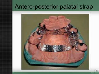 Antero-posterior palatal strap
30
 