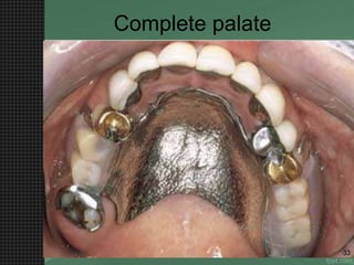 Complete palate
33
 