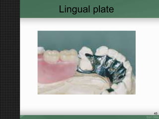 Lingual plate
45
 