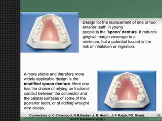 Design for the replacement of one or two
anterior teeth in young
people is the 'spoon' denture. It reduces
gingival margin coverage to a
minimum, but a potential hazard is the
risk of inhalation or ingestion.
A more stable and therefore more
widely applicable design is the
modified spoon denture. Here one
has the choice of relying on frictional
contact between the connector and
the palatal surfaces of some of the
posterior teeth, or of adding wrought
wire clasps.
63Connectors -J. C. Davenport, R.M.Basker, J. R. Heath, J. P. Ralph, PO. Glantz,
and P. Hammond (BDJ)
 