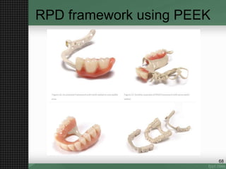 RPD framework using PEEK
68
 