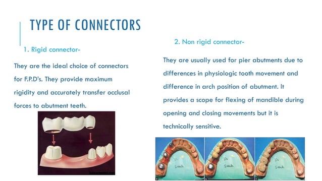 Tooth Connection Engineering CONNECTORS AND SOLDERS IN FIXED DENTAL PROSTHESIS | PPTX