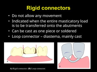 Comprehensive Overview of Connectors in Fixed Partial Dentures: Types ...