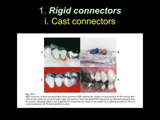 Real Form Connectors Comprehensive Overview of Connectors in Fixed Partial Dentures: Types ...