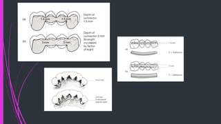 Predisposition Connector CONNECTORS in fixed prosthodontics ( Rig) | PPTX