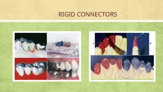 CONNECTORS IN FIXED PARTIAL DENTURE.pptx