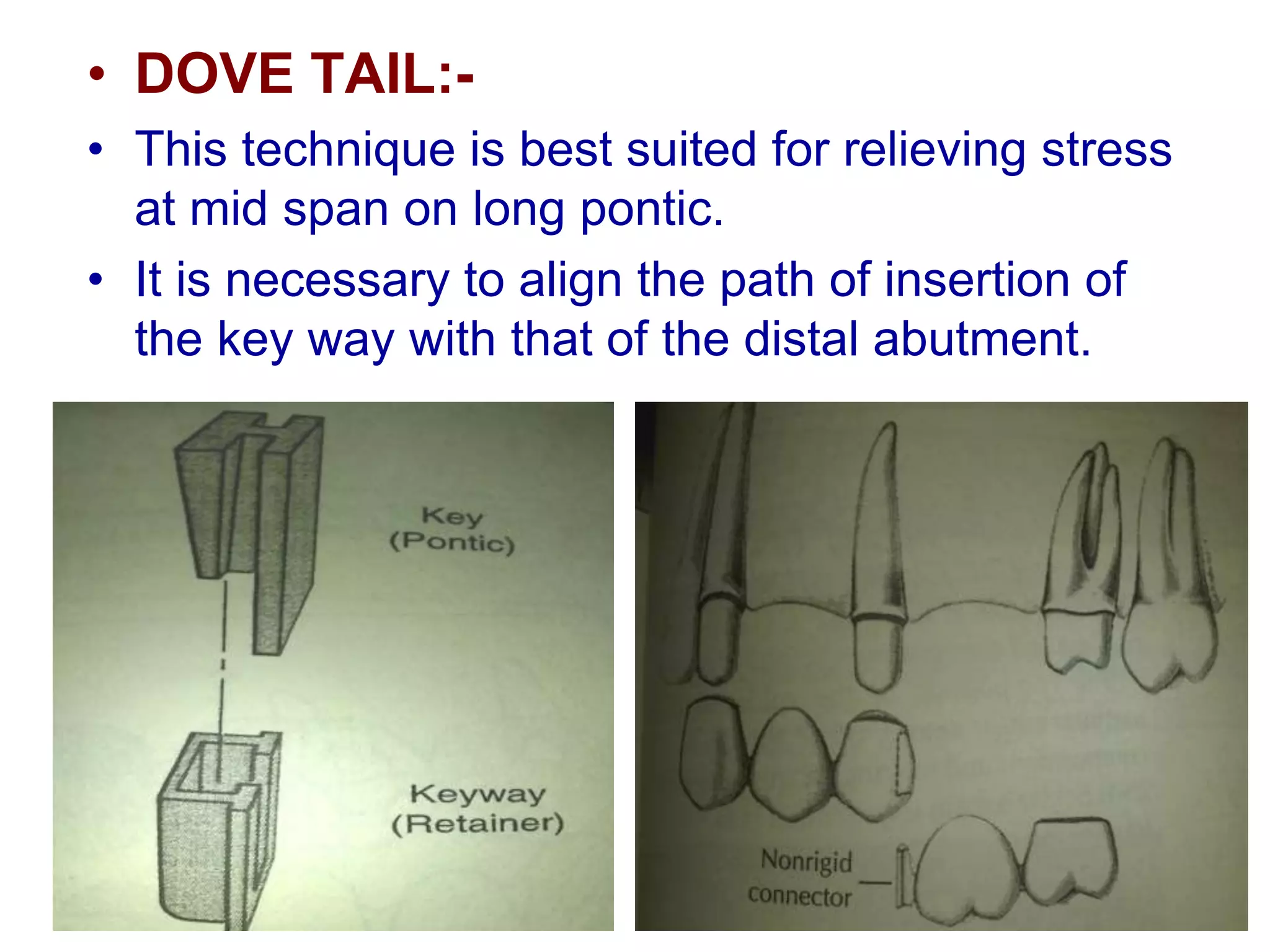 • DOVE TAIL:-
• This technique is best suited for relieving stress
at mid span on long pontic.
• It is necessary to align the path of insertion of
the key way with that of the distal abutment.
 