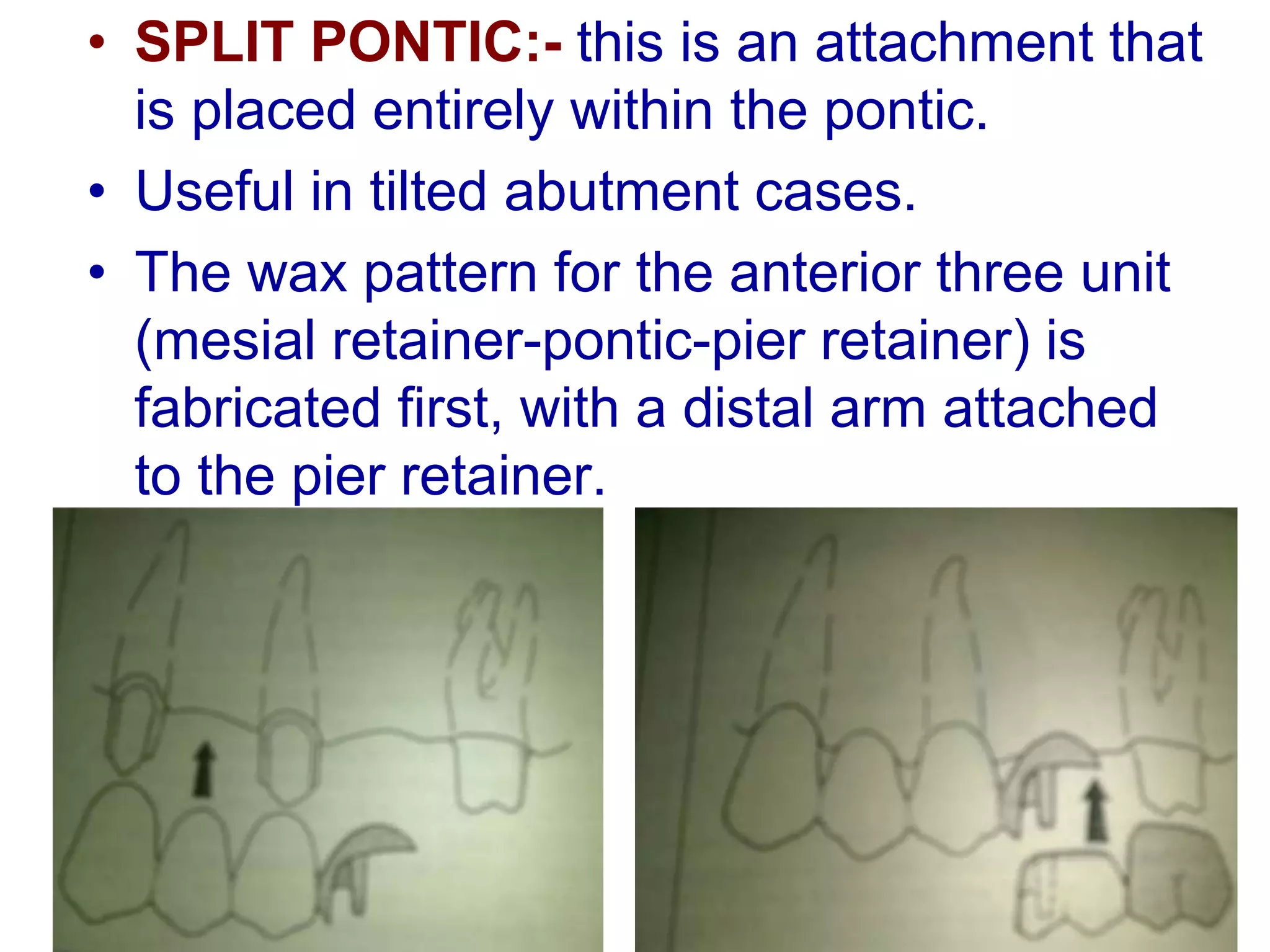 • SPLIT PONTIC:- this is an attachment that
is placed entirely within the pontic.
• Useful in tilted abutment cases.
• The wax pattern for the anterior three unit
(mesial retainer-pontic-pier retainer) is
fabricated first, with a distal arm attached
to the pier retainer.
 