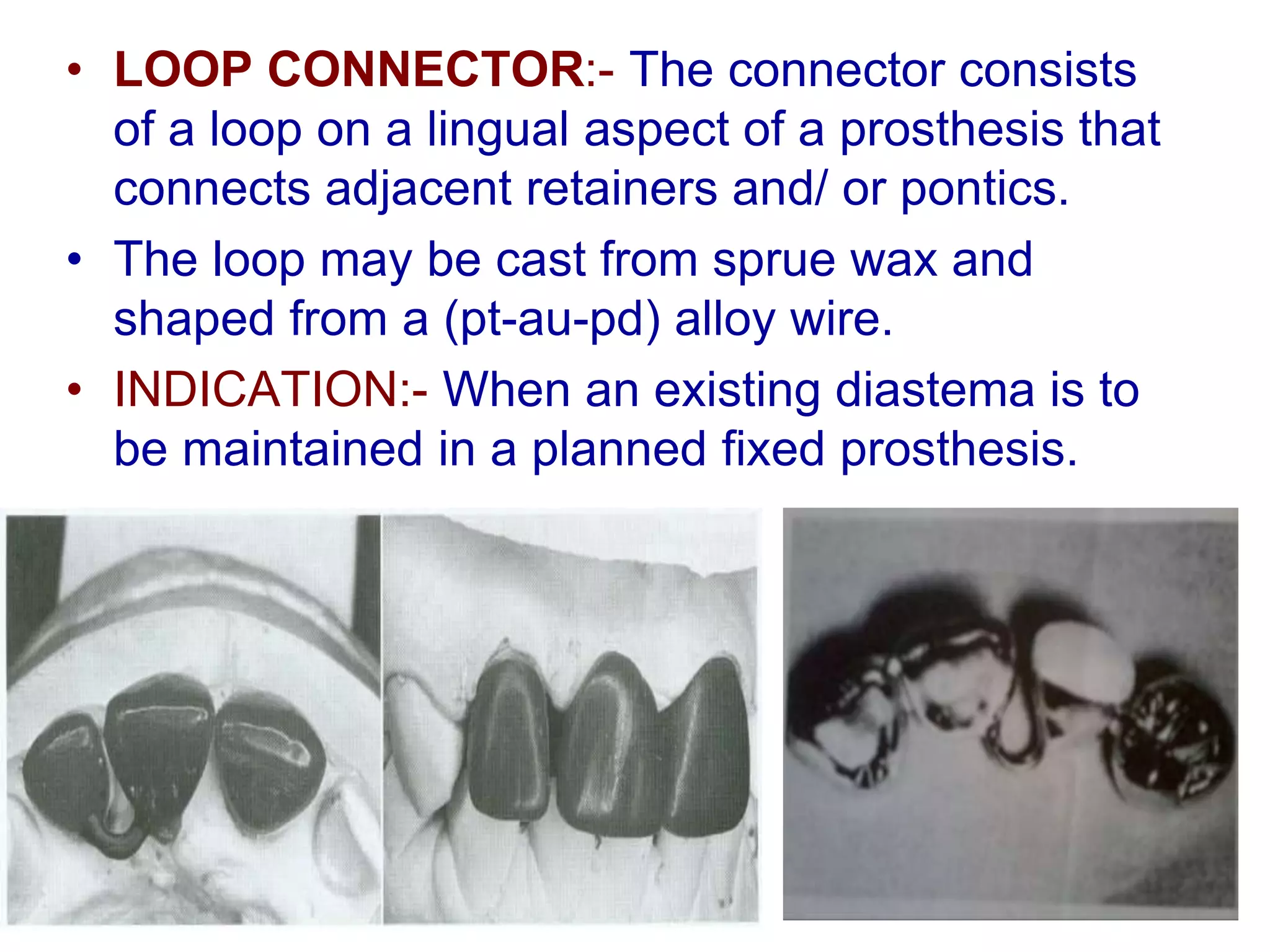 • LOOP CONNECTOR:- The connector consists
of a loop on a lingual aspect of a prosthesis that
connects adjacent retainers and/ or pontics.
• The loop may be cast from sprue wax and
shaped from a (pt-au-pd) alloy wire.
• INDICATION:- When an existing diastema is to
be maintained in a planned fixed prosthesis.
 