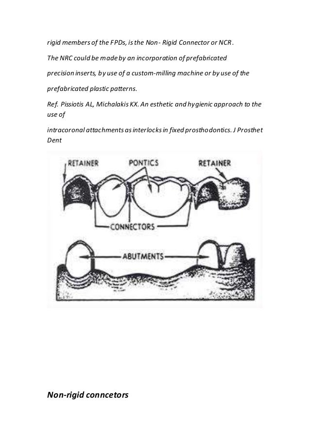 Connectors in fixed prosthodontics