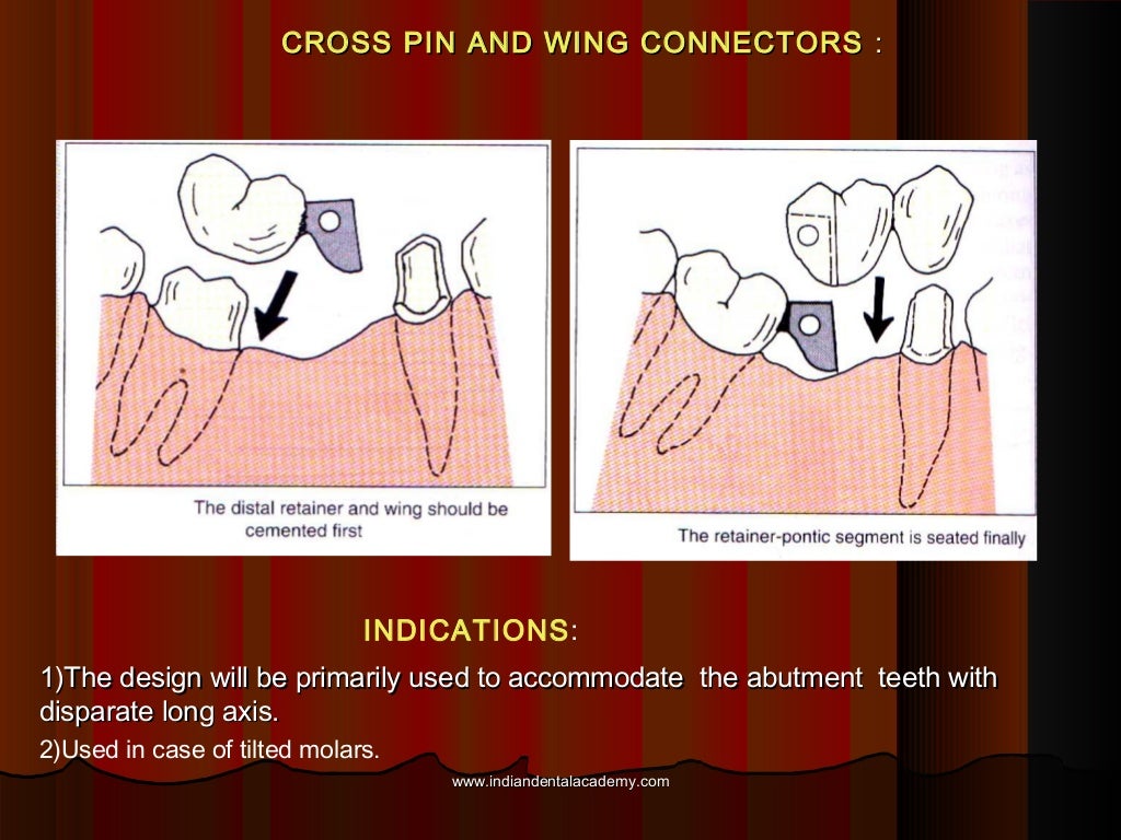 Connectors in fpd continued dental education
