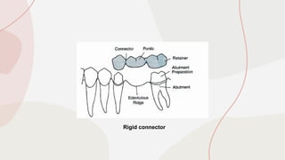 Connectors in Fixed Prosthodontics DENTISTRY | PPTX